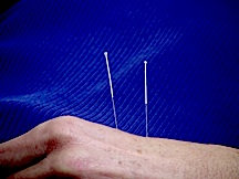 closeup_patient_needles